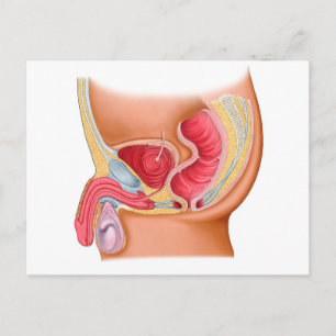 Carte Postale Illustration Médicale D'Une Fistule Rectouréthrale