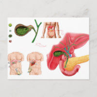 Illustration montrant la cholécystectomie