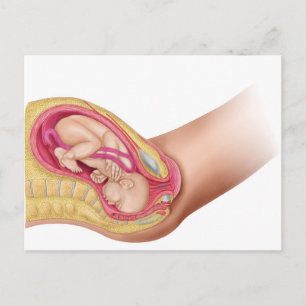 Carte Postale Illustration Montrant La Livraison Du Foetus 2