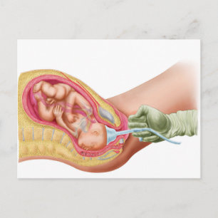 Carte Postale Livraison Du Foetus À L'Aide De L'Extraction Vacue