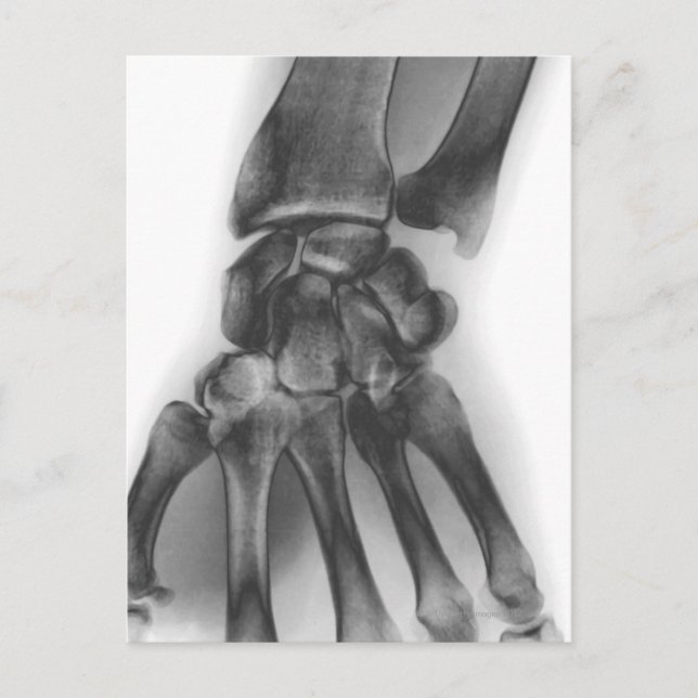 Carte Postale Normal wrist, X-ray (Devant)