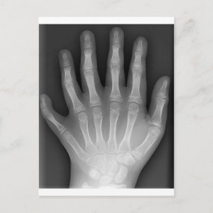 Carte Postale Polydactylo, Six Doigts, X-Ray, rareté !