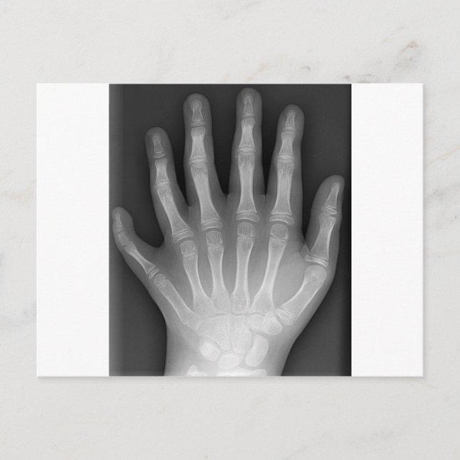 Carte Postale Polydactylo, Six Doigts, X-Ray, rareté ! (Devant)