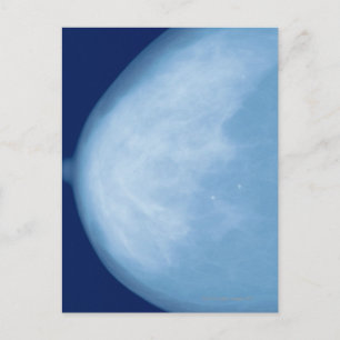 Carte Postale Rayon X du sein féminin, vue latérale