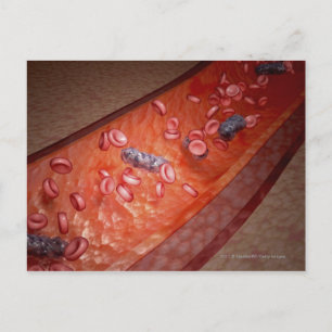 Carte Postale Rendu microscopique d'une infection sanguine