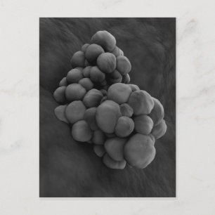 Carte Postale Vue Microscopique De La Tumeur 1