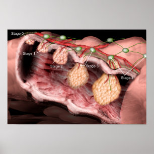 Colon cancer poster