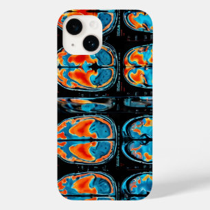 Coque Case-Mate iPhone IRM cérébrale