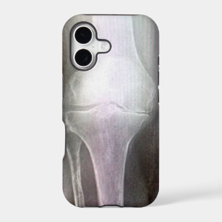 COUVERTURE DU RAYON X IPHONE DE GENOU