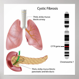 Cystic fibrosis Poster