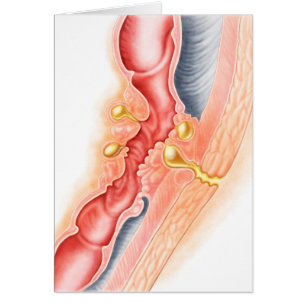 Développement de fistule
