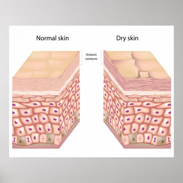 Dry skin Poster (Devant)