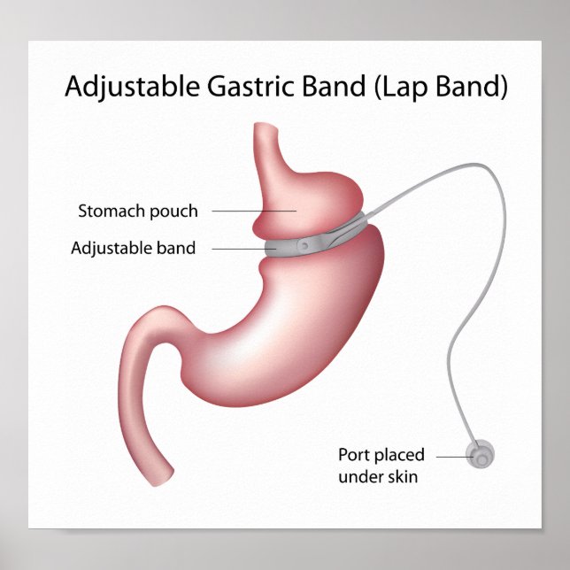Gastric Band Weight Loss Surgery  Poster (Devant)