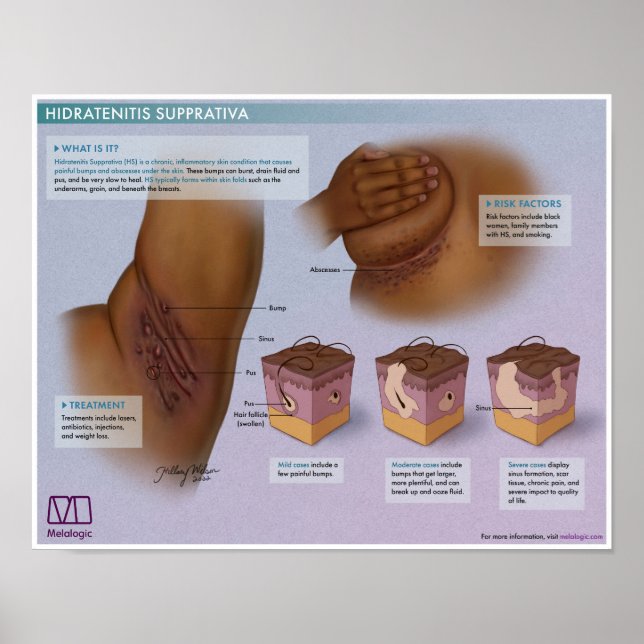 Hidradenitis Melalogique Supprativa Poster Médical (Devant)