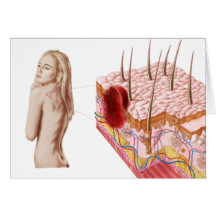 Illustration D'Une Croissance Atypique Sur La Peau