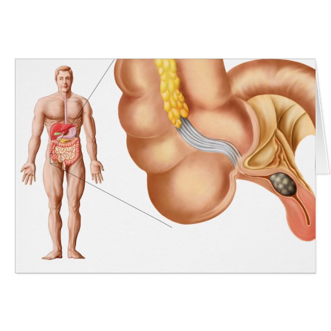 Illustration Médicale D'Un Appendice (Devant horizontal)