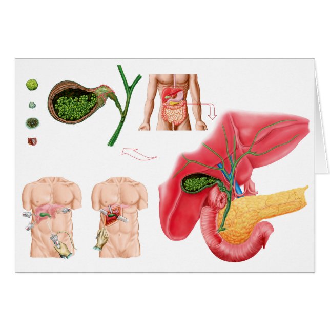 Illustration montrant la cholécystectomie (Devant horizontal)