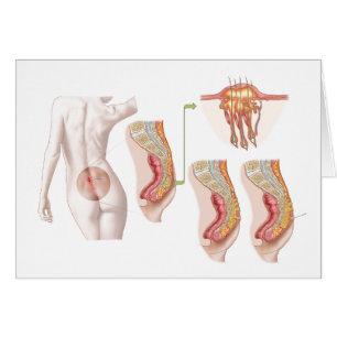 Ilustration Médicale d'un kyste Pilonidal