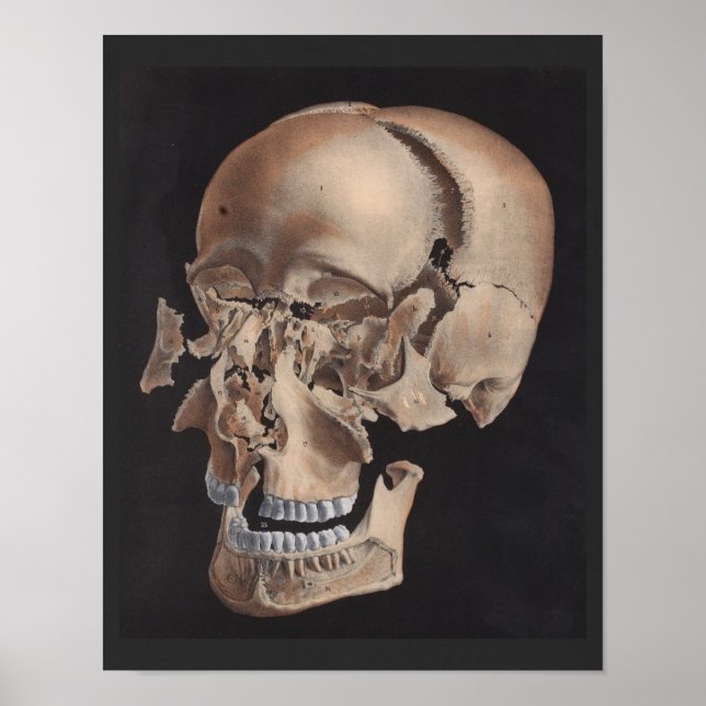 Impression du crâne éclaté désarticulé (Devant)