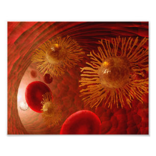 Impression Photo Affiche de métastase du cancer