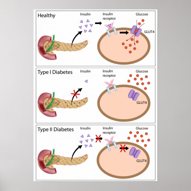 Insulin action and diabetes type 1 and 2 Poster (Devant)
