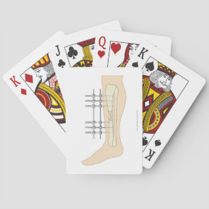 Jeu De Cartes Fixateur externe