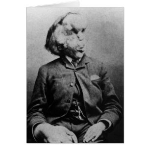 Joseph "John" Merrick L'homme éléphant de 1889