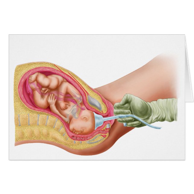 Livraison Du Foetus À L'Aide De L'Extraction Vacue (Devant horizontal)