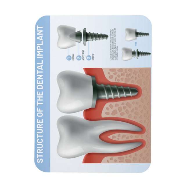 Magnet Flexible Structure de l'implant dentaire (Vertical)