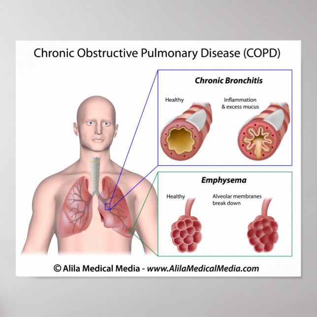 Maladie pulmonaire MPOC étiqueté Poster (Devant)