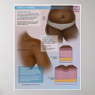 Marques d'étirement Melalogique Poster Médicale