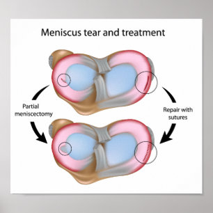 Meniscus larme et chirurgie Poster