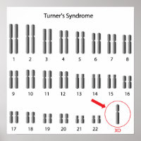 Monosomy X, Syndrome de Turner Poster