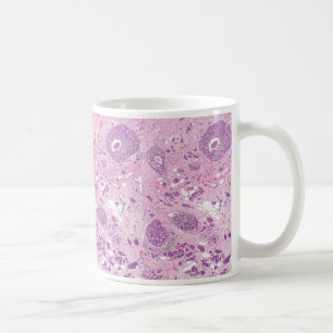 Mug Cellules cancéreuses de Tasse-Sein de café