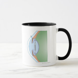 Mug Chirurgie de cataracte