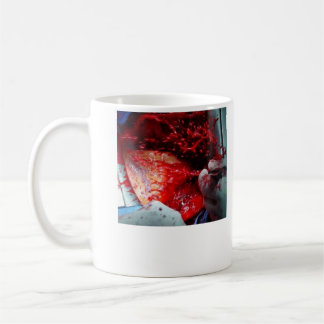 Mug Dissection aortique croissante