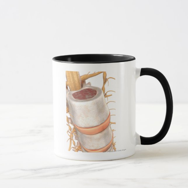 Mug Fermez-vous d'un disque invertebral dans l'épine (Droite)