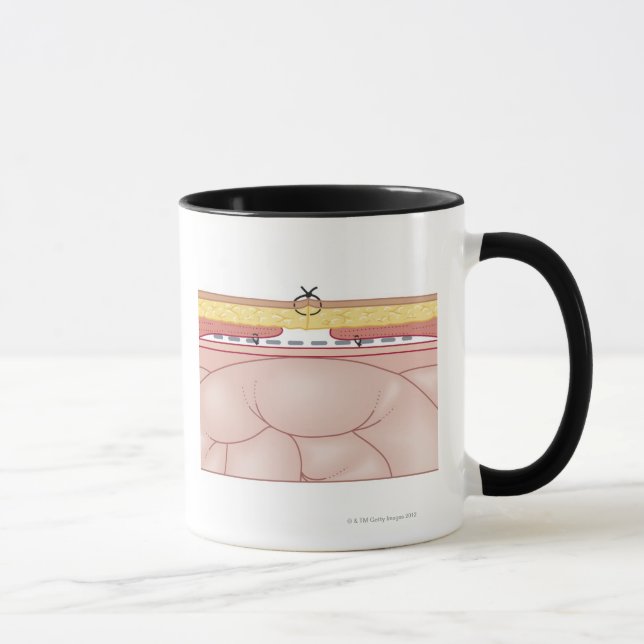 Mug Illustration d'une hernie (Droite)