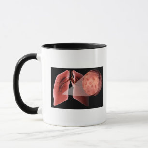 Mug Voie aérienne d'Inflammed pendant une crise