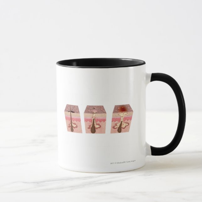 Mug Vue de ce qui cause l'acné (Droite)