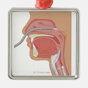 Ornement Carré Argenté Endoscopie du nez