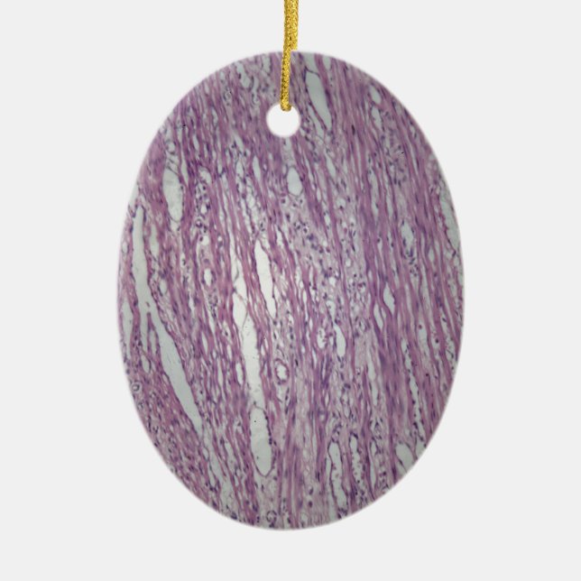 Ornement En Céramique Cellules de tissu humain d'utérus avec le tumo (Devant)