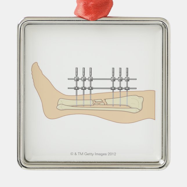 Ornement En Métal Fixator externe (Devant)