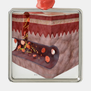 Ornement En Métal Formation de caillot sanguin