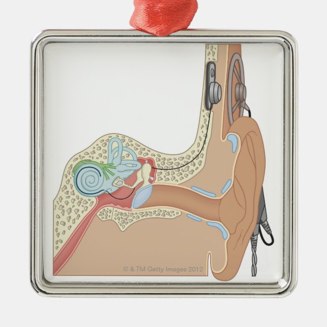 Ornement En Métal Implants cochléaires (Devant)