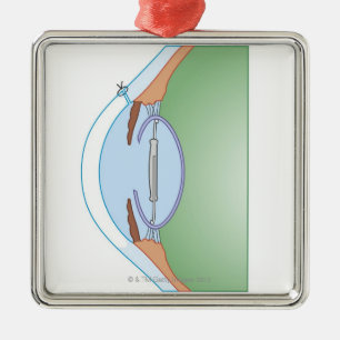 Ornement Métallique Chirurgie de cataracte
