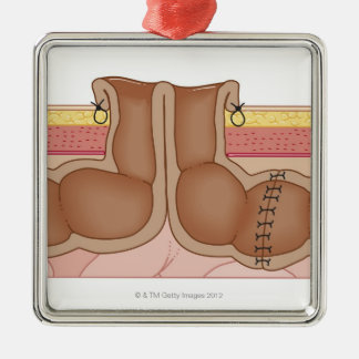 Ornement Métallique Colostomie provisoire