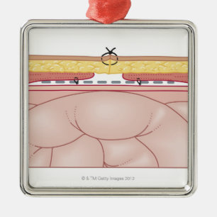 Ornement Métallique Illustration d'une hernie