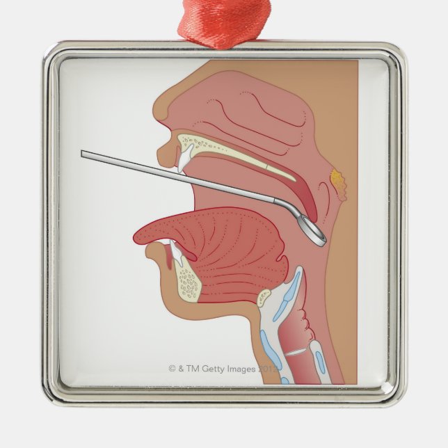 Ornement Métallique Laryngoscopie de miroir (Devant)