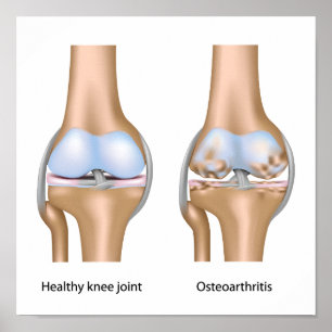 Osteoarthritis of knee joint Poster